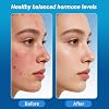 Hormonal Acne Supplement, Clear Skin Supplement with Zinc, Natural D Supplement - Skin Care Vitamins - Hormone Balance, Antioxidants - Gluten Free, Cruelty Free, 60 Capsules