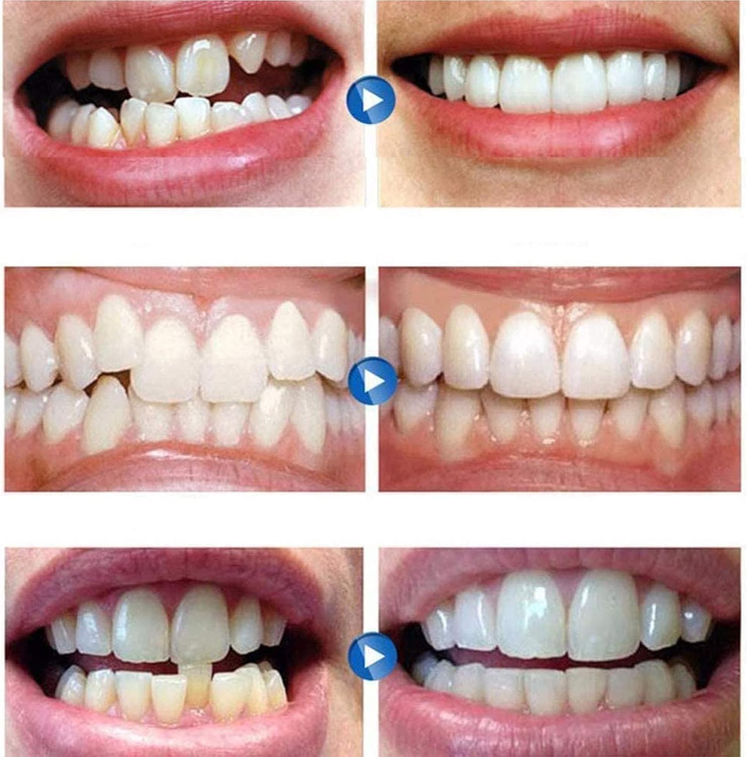 Générique Silicone Reline Denture Set Silicone Reline Denture Set Kit De Regarnissage De Prothèses Dentaires Adhésifs pour Prothèses Dentaires