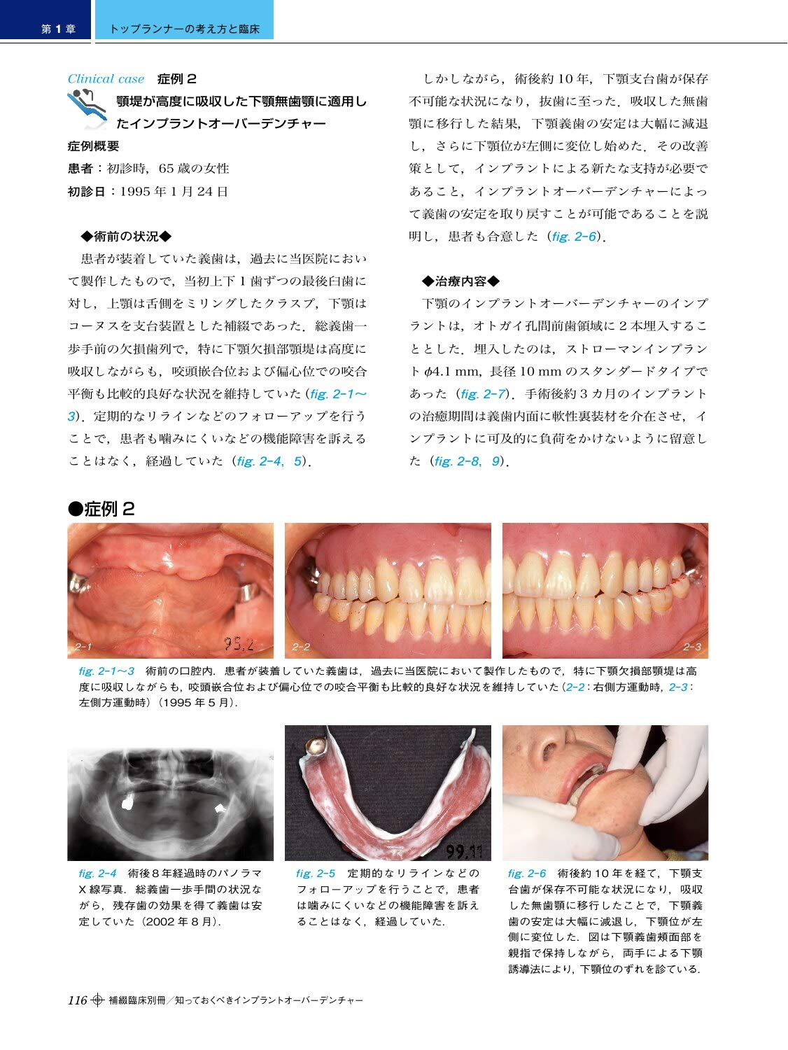 裁断済・新インプラントオーバーデンチャーの基本と臨床 磁性