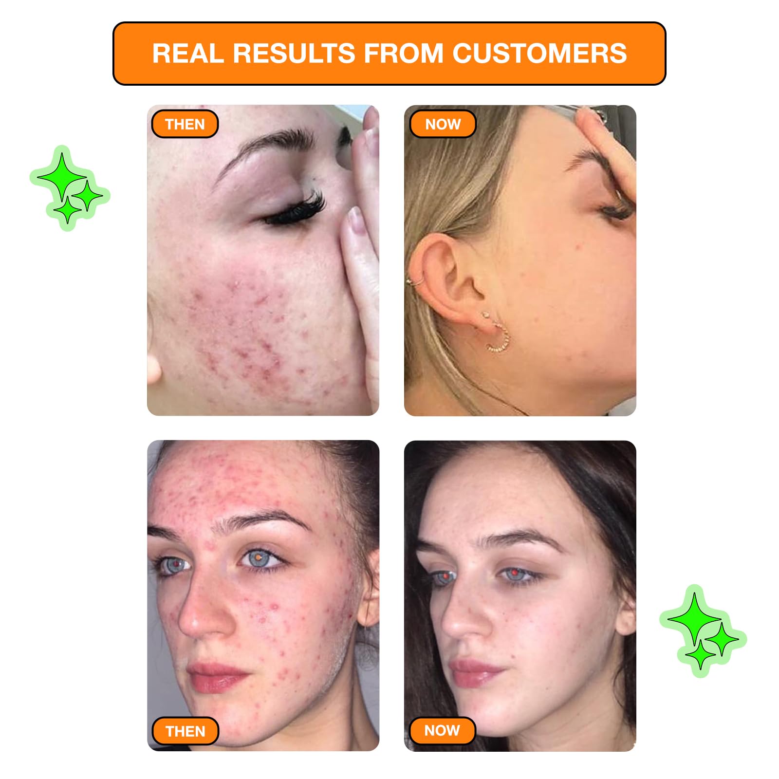 Carbon Theory Hydrocolloid Spot Patches with Vitamin C Dart for Whiteheads and Blemishes 9 Patches, Vegan and Cruelty-Free - Image 4