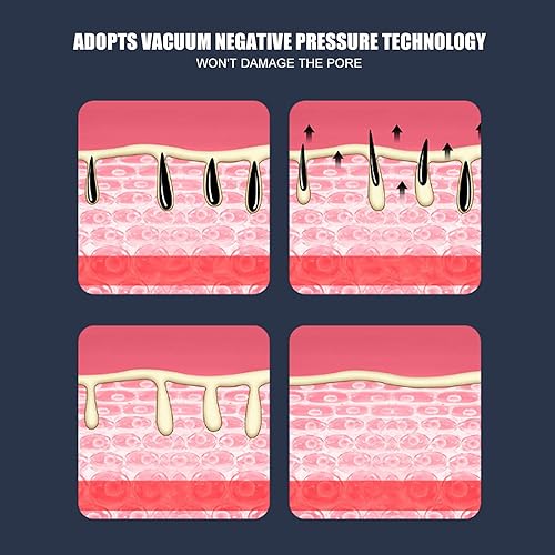 Miniatura 6 de Removedor eléctrico de puntos negros, aspiradora de poros para eliminar puntos negros, extractor de acné facial, herramienta de succión recargable,