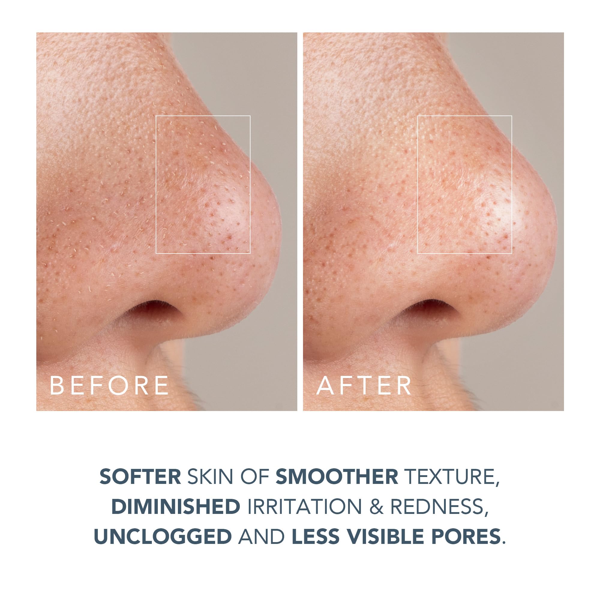 FOREO KIWI derma Dispositivo microdermoabrasione esfoliante levigante Aspiratore punti neri viso + Maschera pori punti neri 100g