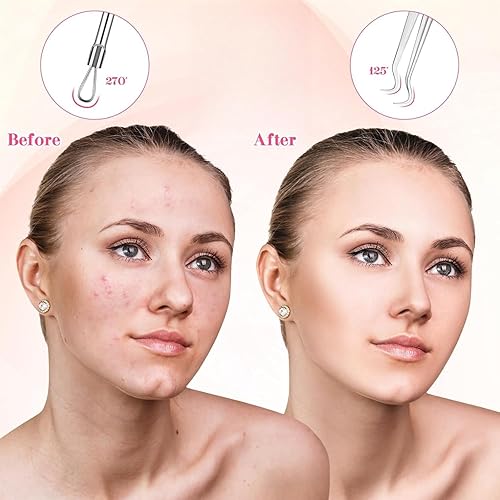 Miniatura 5 de Extractor de comedones para eliminar puntos negros, herramienta de extracción de espinillas de acero inoxidable, kit de pinzas curvadas para puntos