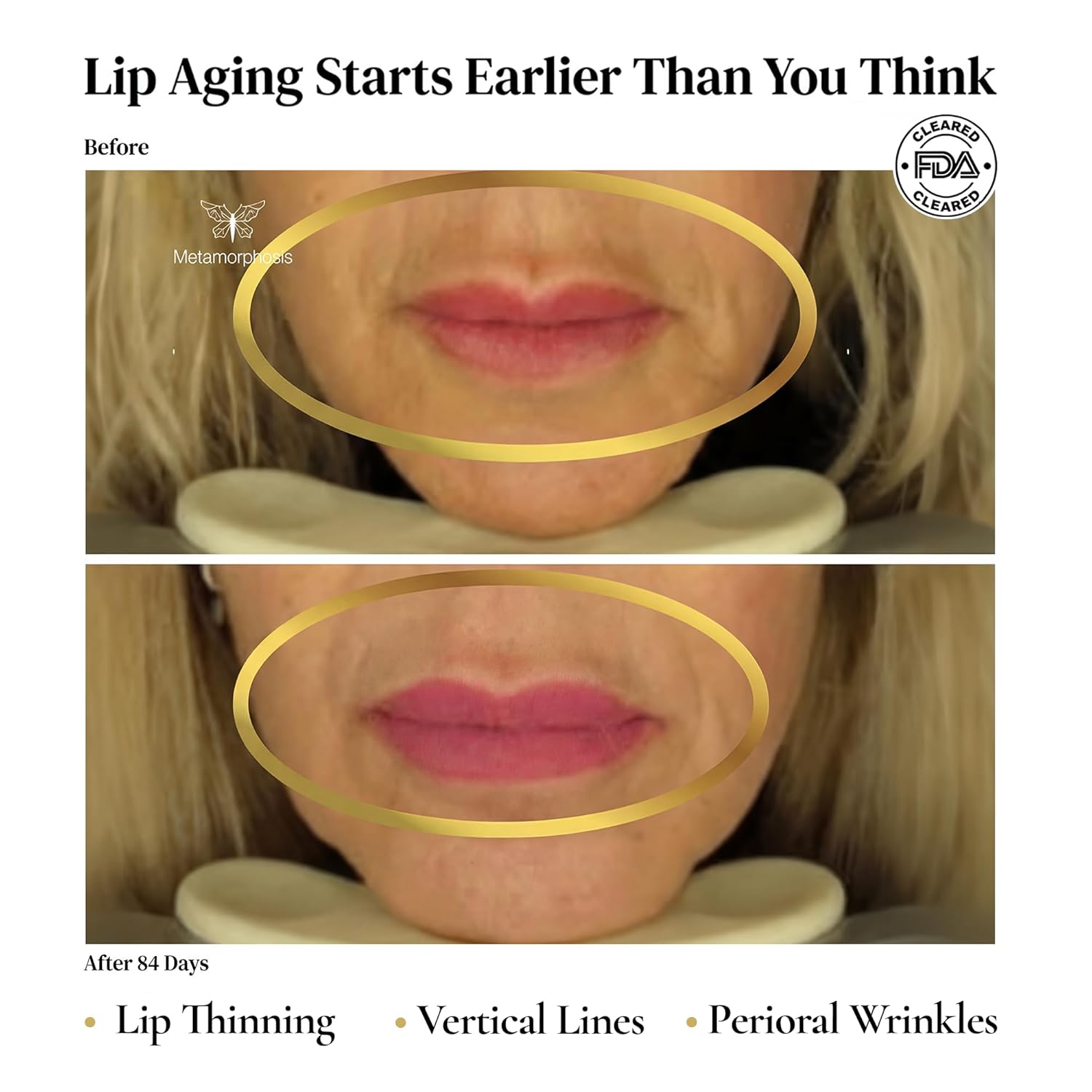 Metamorphosis LushLips LED Lip Therapy Device, FDA-Cleared for Wrinkle Reduction, Fuller Lips and Smoother Lines, No Biting Required, 4 Wavelengths, Award-Winning, Rechargeable Case