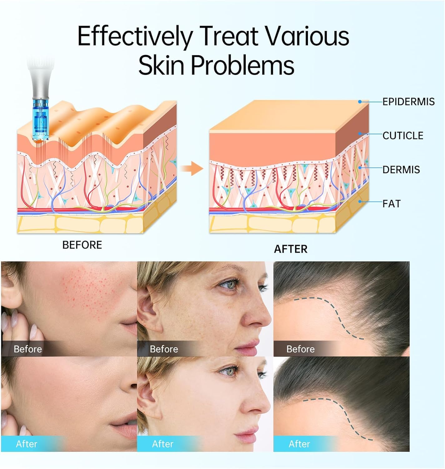 Dr.Pen M8S Microneedling Pen - Kit di strumenti per la cura della pelle, per anti-invecchiamento, cicatrici da acne, rughe, con 5 pezzi a 18 pin + 5 cartucce a 36 pin