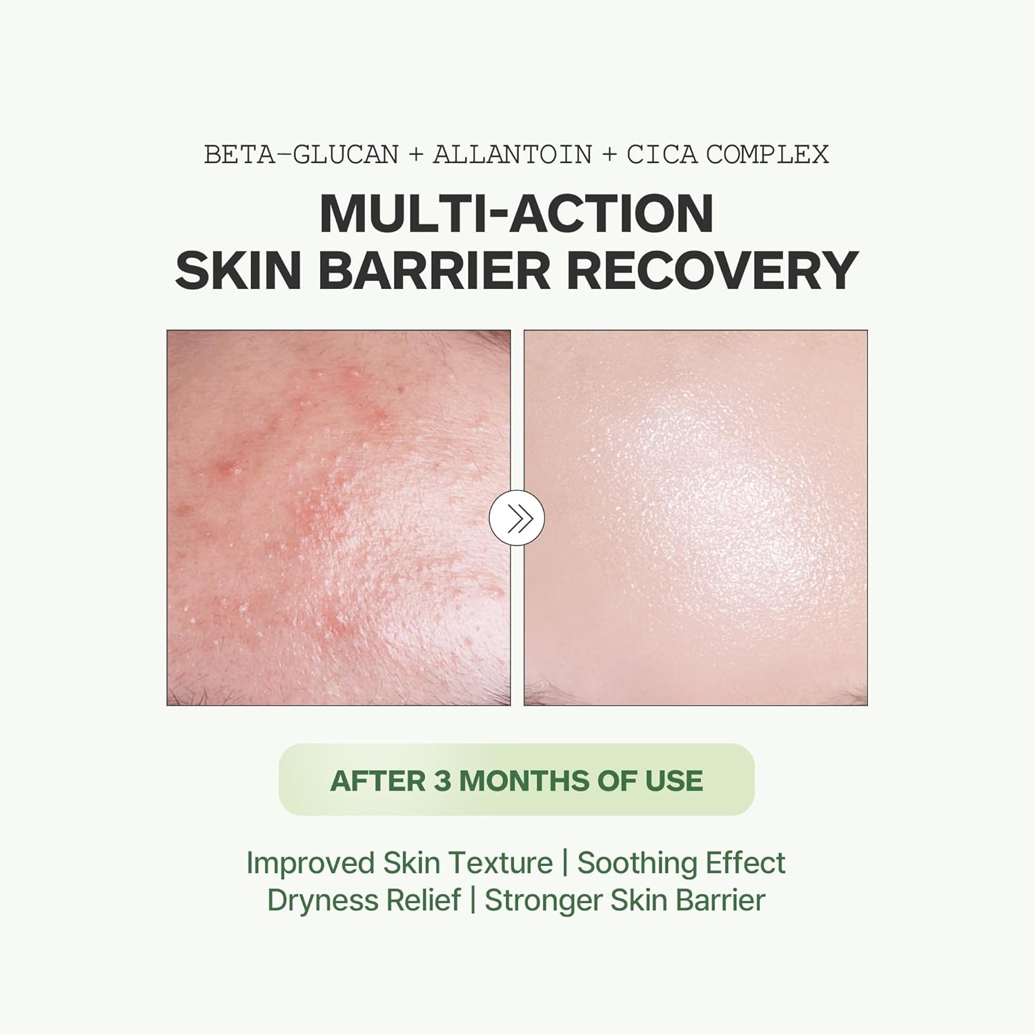 Beta Calming-Cure Essential Cream – 67% Hinoki Cypress Water, Hydrating Face Moisturizer, Soothing & Barrier Repair for Sensitive Skin, Korean Skin Care, 50ml/1.69fl.oz - Image 5