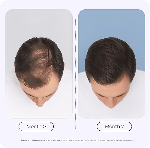 Miniatura 4 de Complex10 Suplemento de apoyo para el cabello con biotina, colágeno y 10 nutrientes esenciales, apoya un cabello saludable y de aspecto más fuerte,