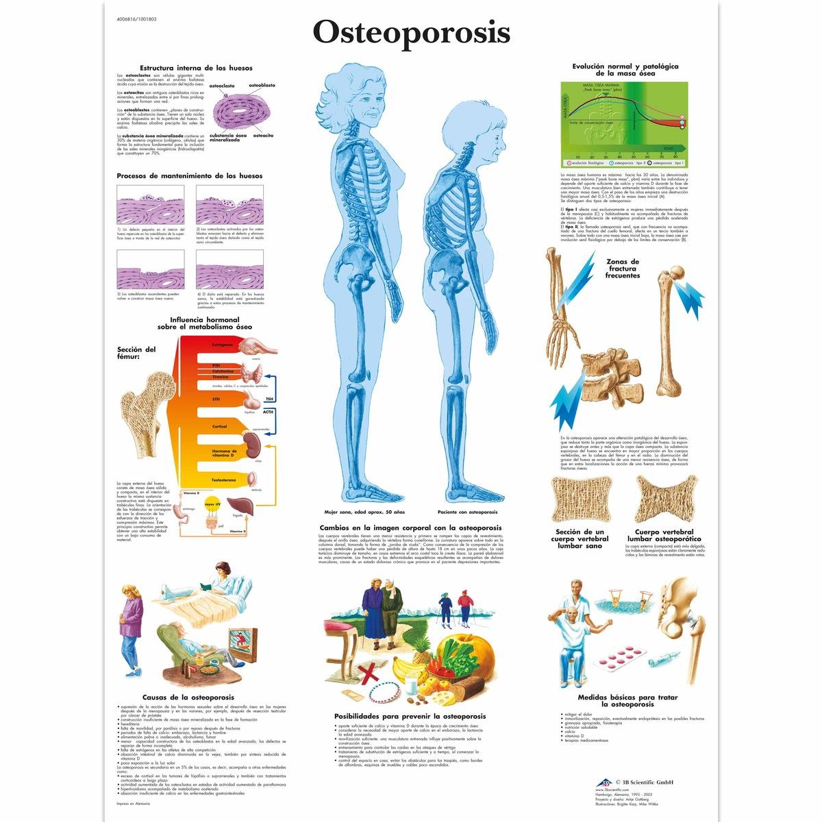 3B Scientific Printed in Paper, Osteoporosis, 1