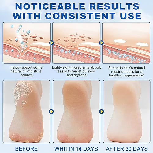 Miniatura 4 de Crema en barra de urea 60% más 2% ácido salicílico, crema de urea para pies y callos de máxima fuerza para talones secos agrietados, manos,