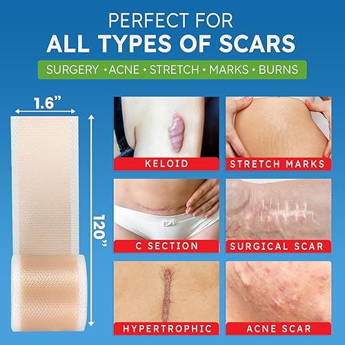 Miniatura 3 de Hojas de cicatriz de silicona, cinta de cicatriz para cicatrices quirúrgicas, cinta de silicona para cicatrices, cesárea, abdominoplastia,