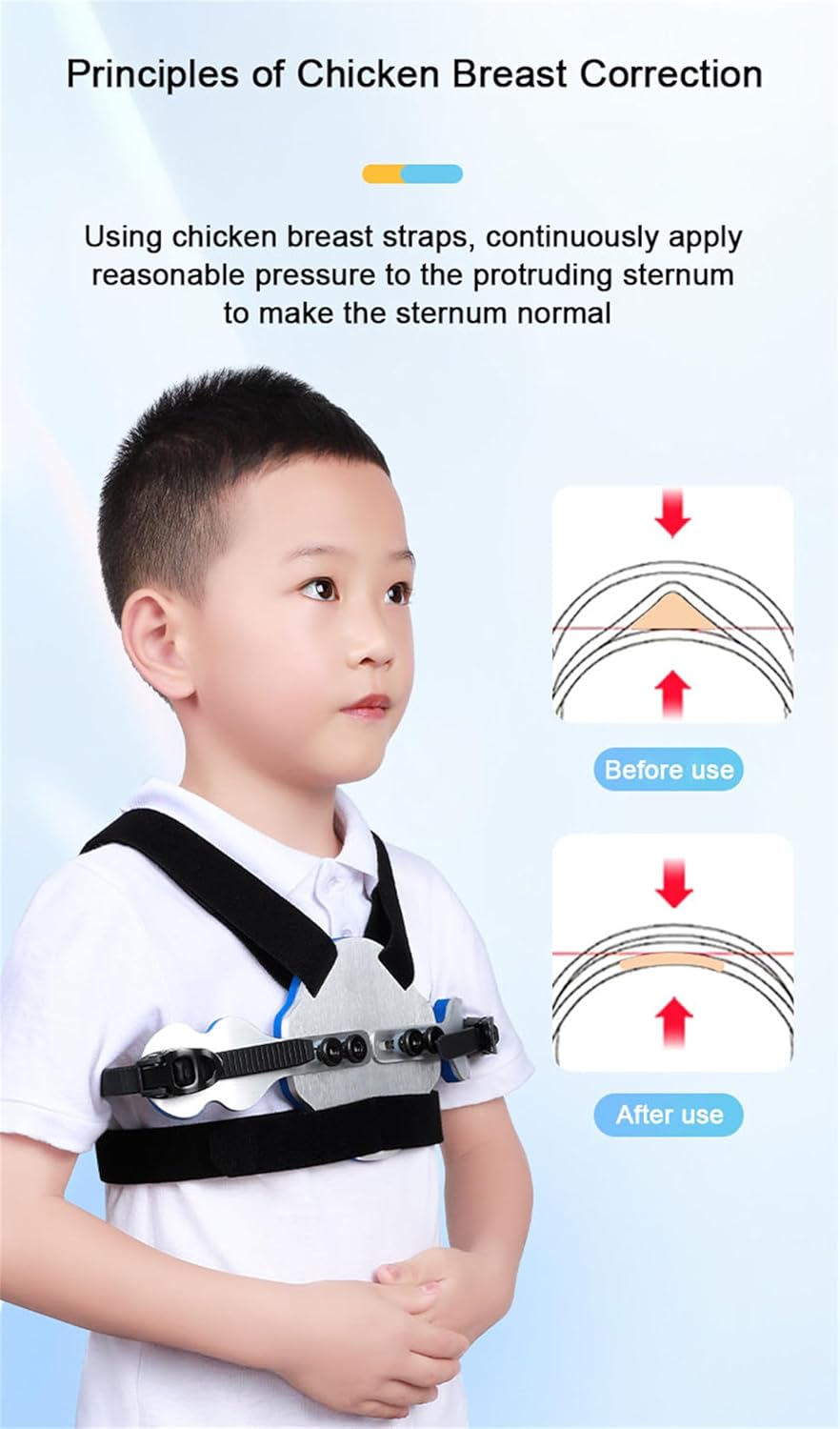 Pectus Carinatum Brace for Kids, Adjustable Chest Support for Pigeon Chest, Comfortable Orthotic Device for Daily Use