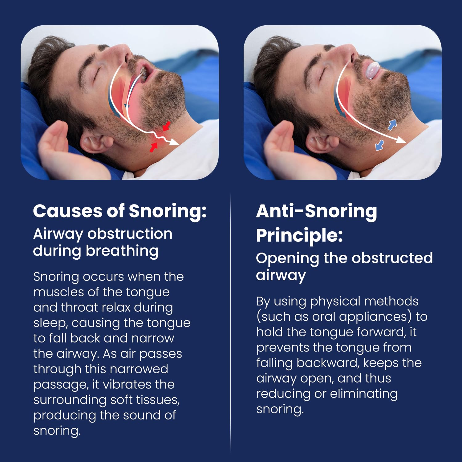 snoring solution - anti snoring device mouthpiece mouth guard comfortable reusable snore stopper bpa-free tongue retainer for better sleep easy to use snore solution for men and women