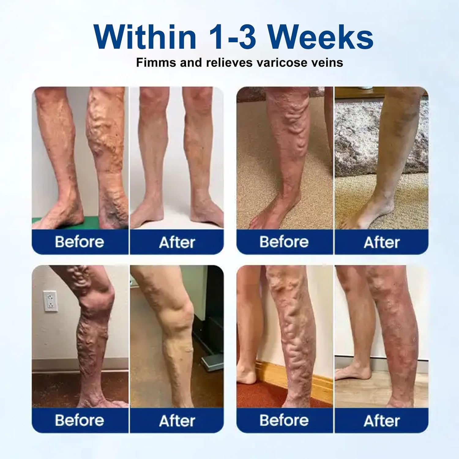 GFOUK Vein Target Microneedle Patch, 2026 Advanced Varicose Veins Treatment for Legs, Gfuel VeinTarget Varicose Veins Patch, Natural Ingredients Leg Treatment for All Skin Types