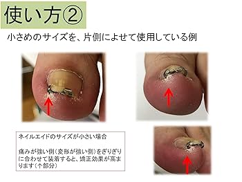 ネイル・エイド NailAid 巻き爪矯正用 2個セット 楽天市場】巻き爪 自分で 巻き爪矯正 【 ネイル・エイド 14mm