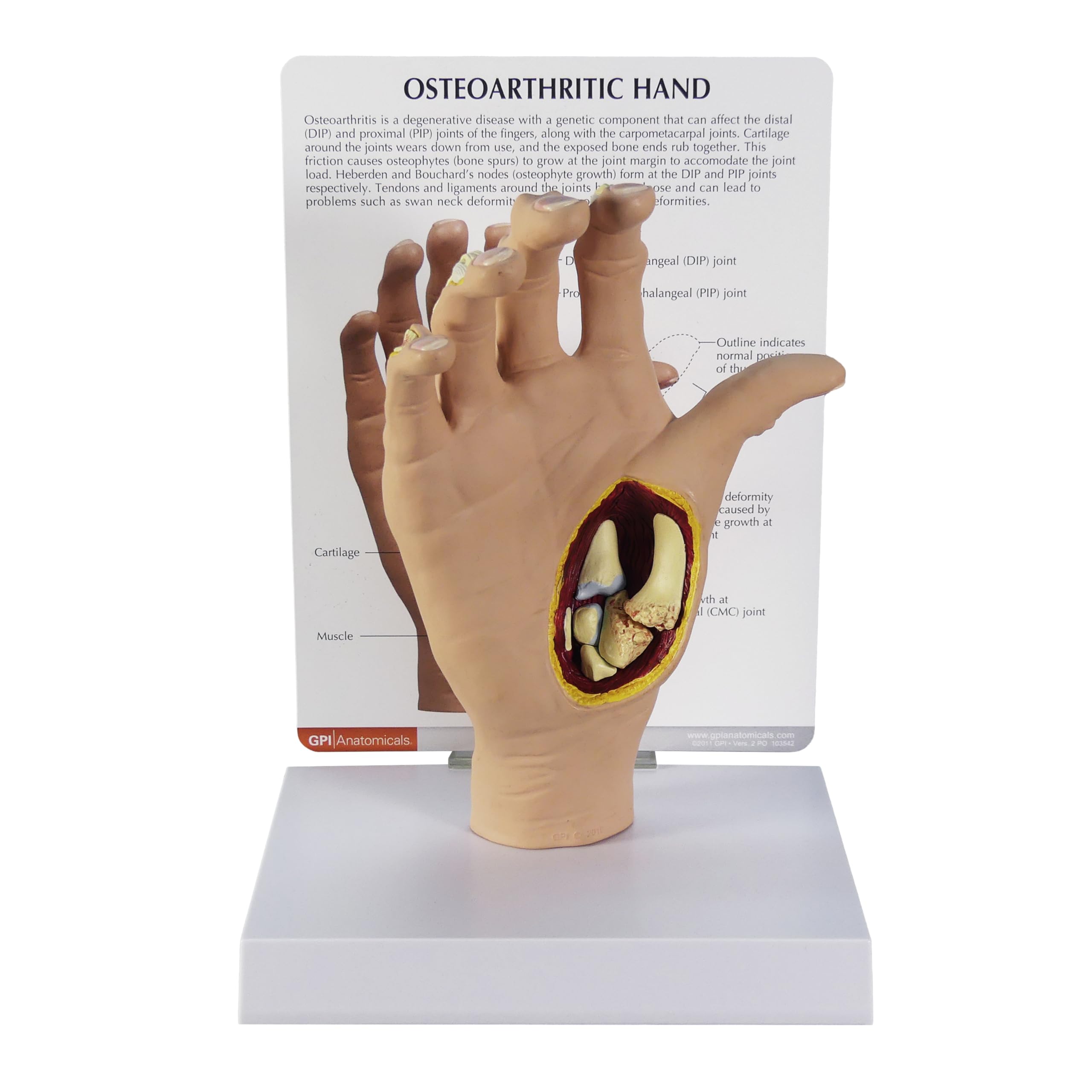 Right Hand Model with Osteoarthritis (OA), Replica for Human Anatomy and Physiology Education, Anatomy Model for Doctor's Office and Classrooms, Medical Learning Resources