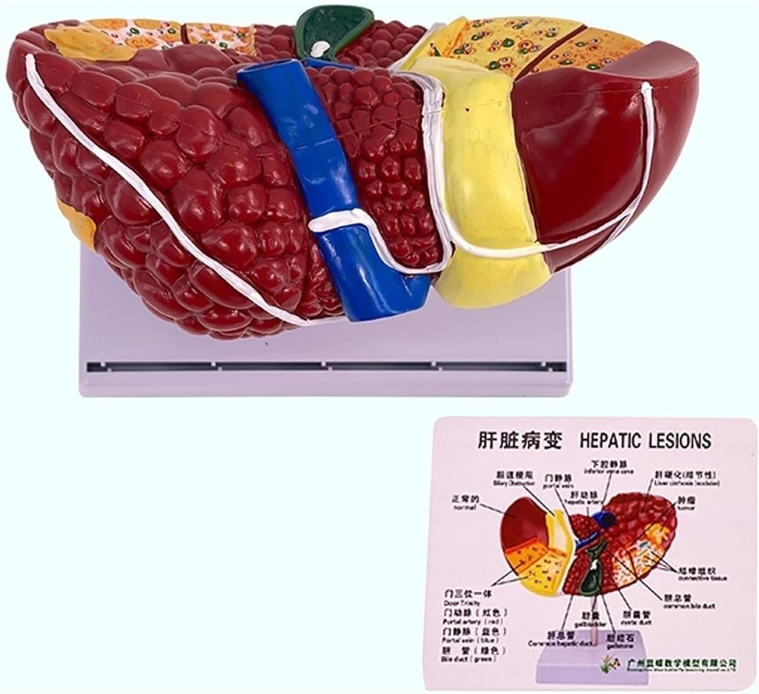 Anatomy Model of Human Liver, Pathological Features of Cirrhosis, Used for Teaching Demonstration
