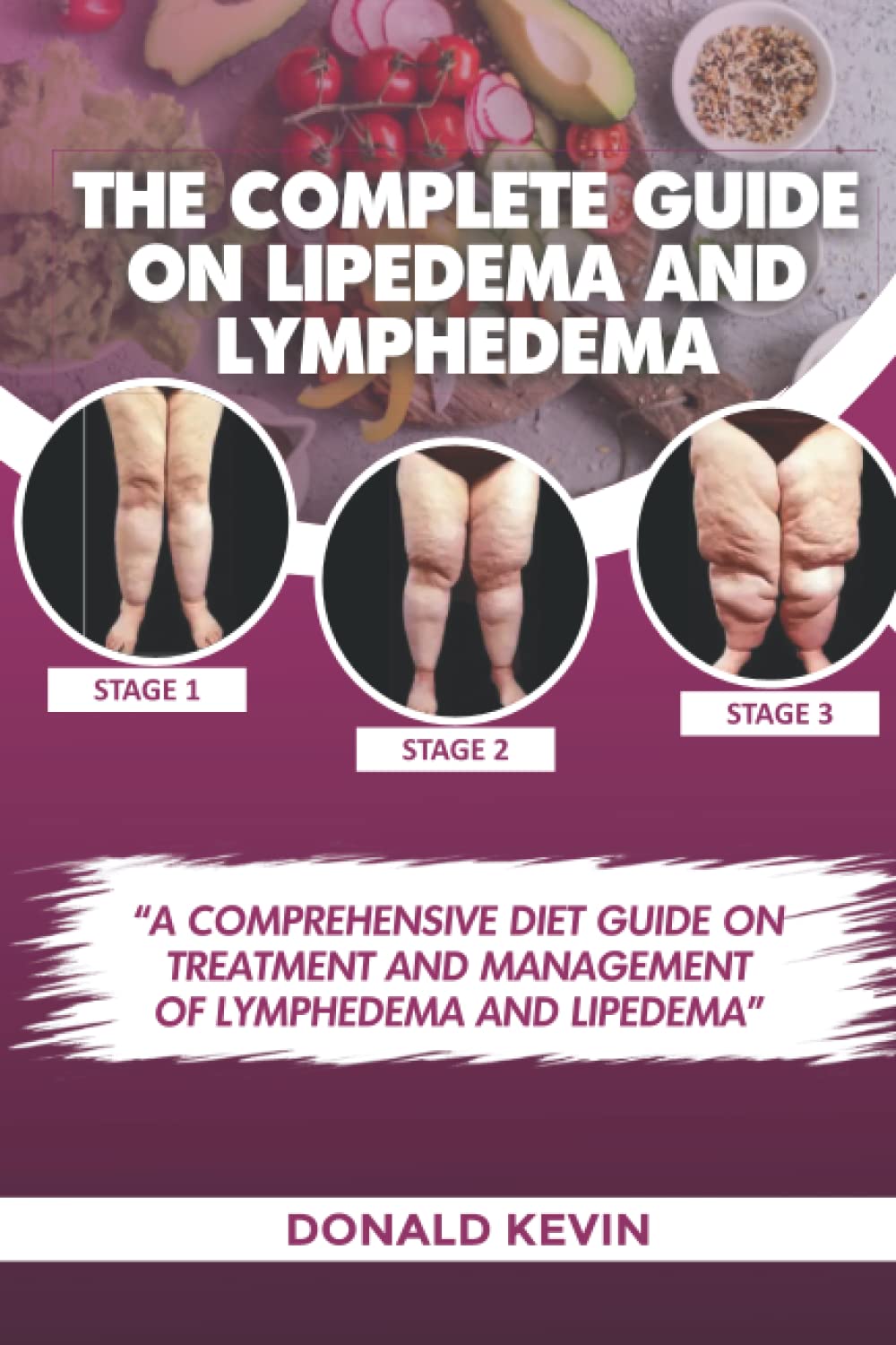 The Complete Guide on Lipedema and Lymphedema: A comprehensive Diet Guide on Treatment and Management of Lipedema and Lymphedema