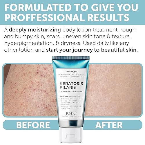 Miniatura 4 de KP Bump Eraser Body Scrub con 10% AHA  Tratamiento de queratosis pilaris  Exfoliante corporal con borrador de bump  Tratamiento de cabello encarnado