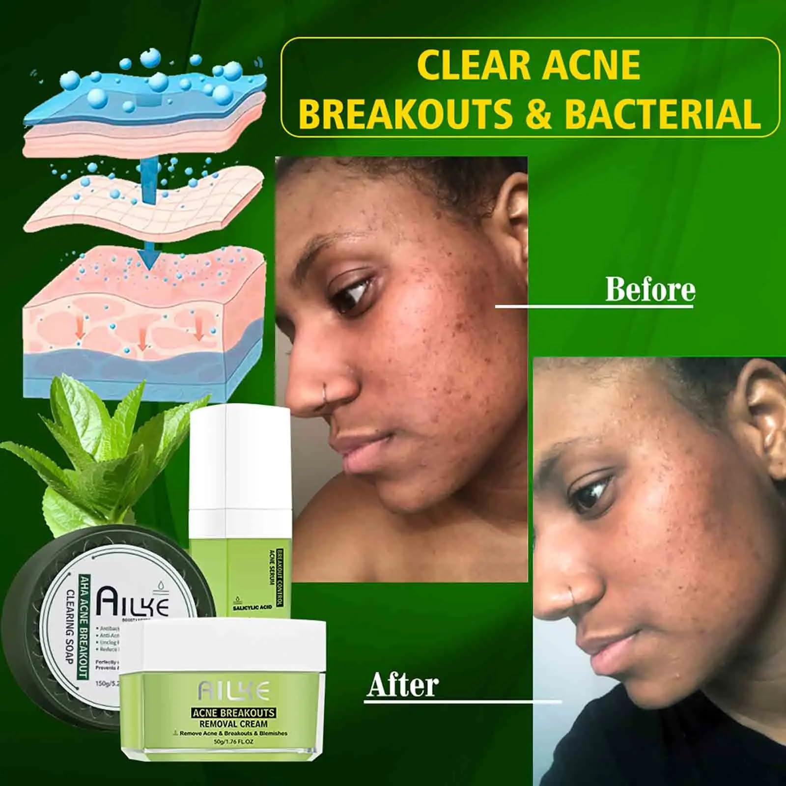 AILKE Salicylic acid Acne Removal Cream, Effectively Anti Acne-prone Skin, Control Breakouts, Reduce Blemishes, Unclog Pores, Repair Post-Acne Marks. All Natural (BREAKOUT CONTROL ACNE 3 in 1 SET)