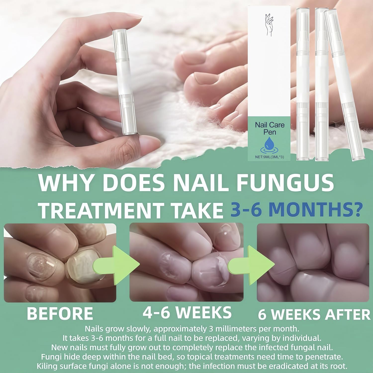 Nagelpilz Stift Original, Schnelle Absorption, präziser Applikator, stärkt und pflegt geschädigte Nägel, geeignet für Hände & Füße (3 stück)