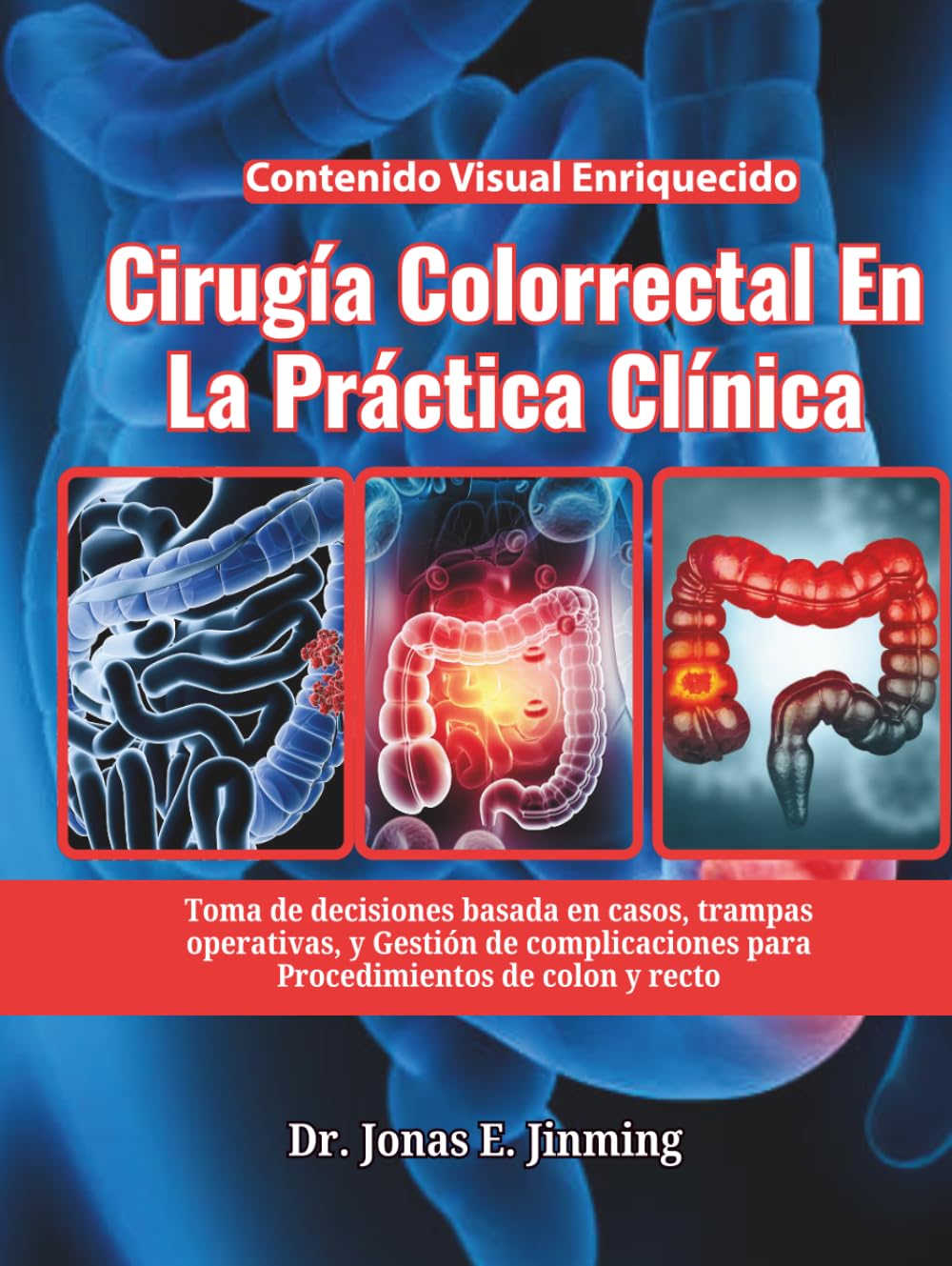 Cirugía Colorrectal En La Práctica Clínica: Toma de decisiones basada en casos, trampas operativas, y Gestión de complicaciones para Procedimientos de colon y recto
