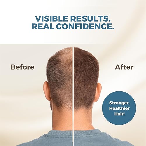 Miniatura 3 de HAIRMETTO® Suero bloqueador tópico DHT para la pérdida del cabello, regeneración del cabello con aceite de palma enana, aceite de ortiga picante,