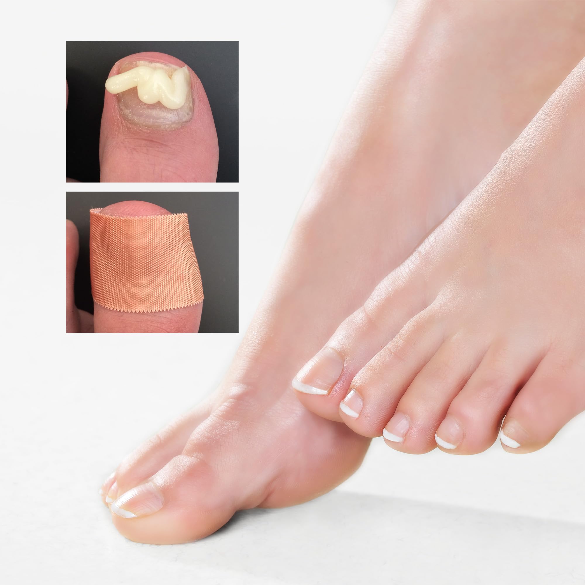 PACT Urea 40 réparation des ongles | en cas de mycose des ongles | kit mycose des ongles | | 40 % d'urée - Ruban adhésif de 5 m - Lime à ongles - Traitement de 2 à 3 semaines - Fabriqué en Allemagne