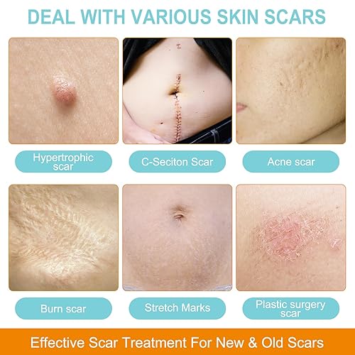 Miniatura 4 de Hojas de silicona para cicatrices (rollo de 1.6 x 150 pulgadas, rollo de 1.6 in x 12.5 ft), tiras de silicona para cicatrices, rollo de cinta de