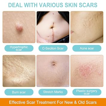 Silicone Scar Sheets (1.6 x 150 Roll-4cm x 3.8M), Scar Silicone Strips, Silicone Scar Tape Roll, Reusable, Professional Scar Removal Sheets for C-Section, Burn, Keloid, Surgery, Acne et