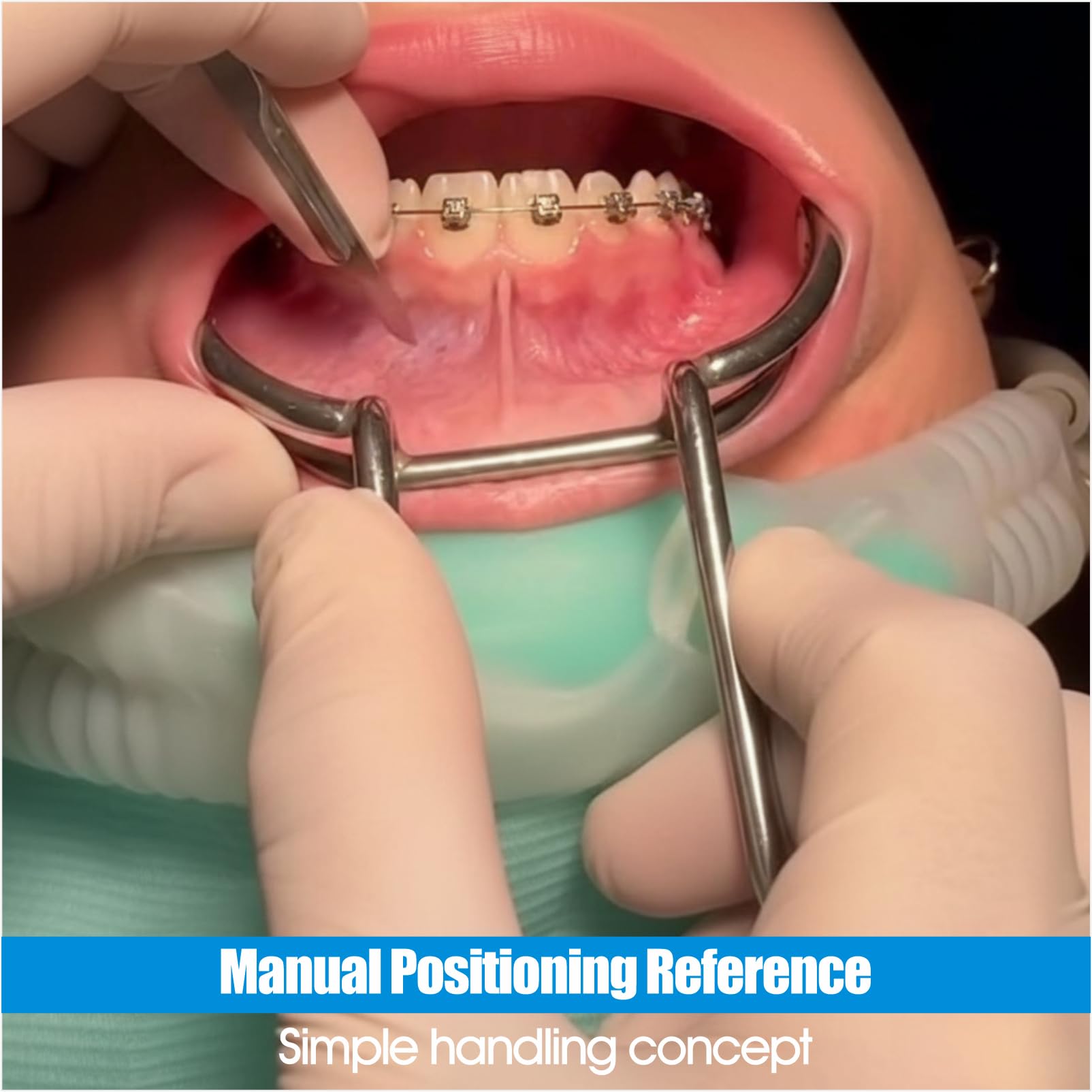 Divaricatore dentale per guance, ortodontico, per labbra e guance, strumento di apertura intraorale della bocca per clinica, sbiancamento dei denti, esame orale e fotografia, confezione da 4