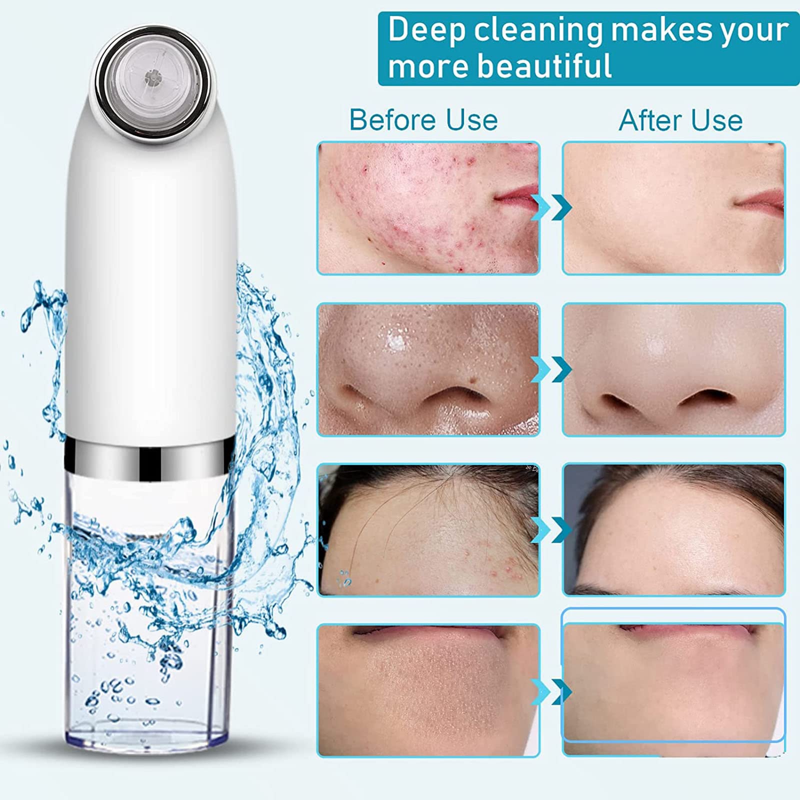 Aspirador de poros para eliminar puntos negros, extractor de espinillas de limpieza facial, herramienta de succión de puntos negros, limpiador de poros faciales, herramienta extractora de puntos