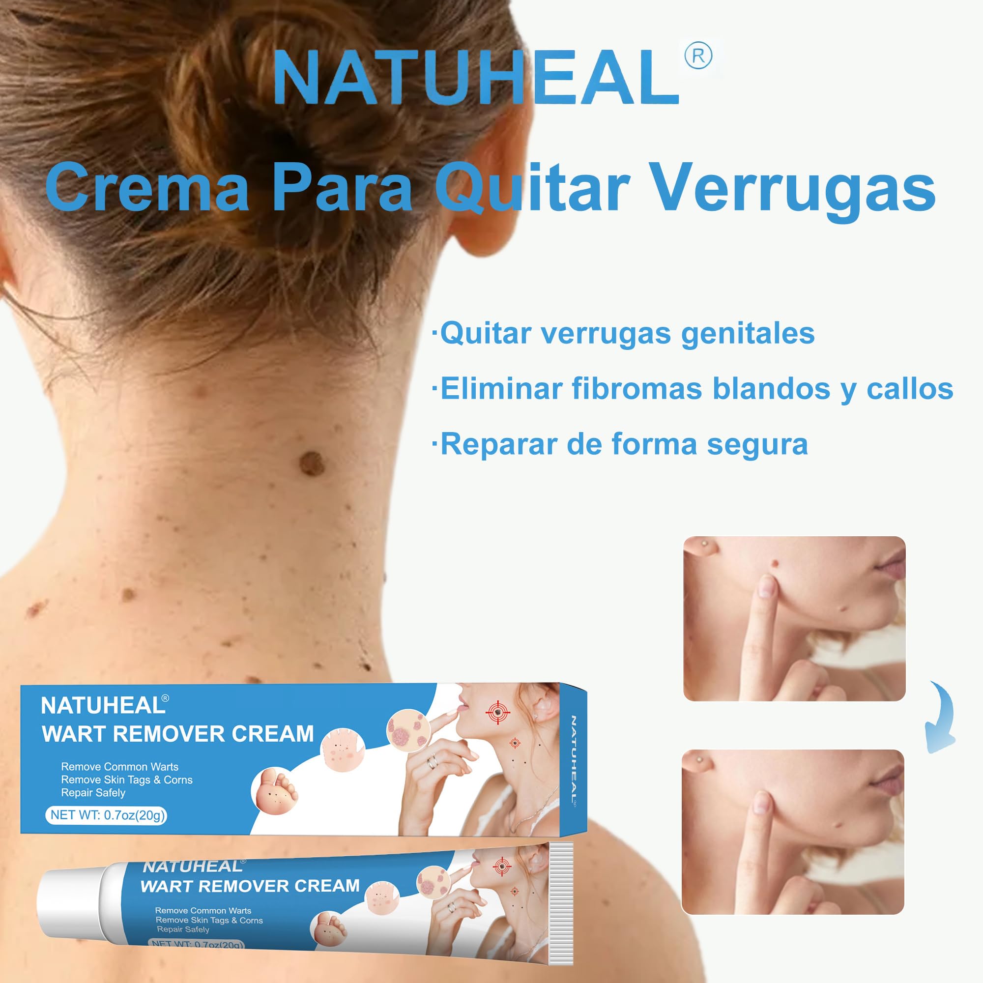 Crema para eliminar verrugas y acrocordones, kit para rostro y cuerpo, eliminación suave de verrugas plantares, comunes, callos y planas, 20 g - 2