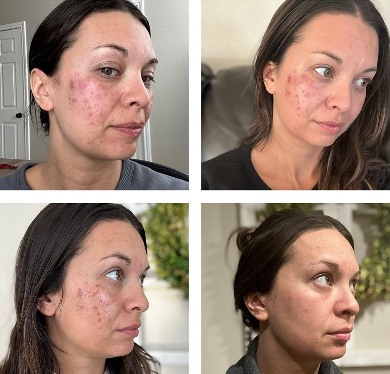TCATherapyCare Solution Acid Peel 90% (Livello 2 pH 1.9) - Esfoliante, texture e tono della pelle - peeling viso - 30 ml