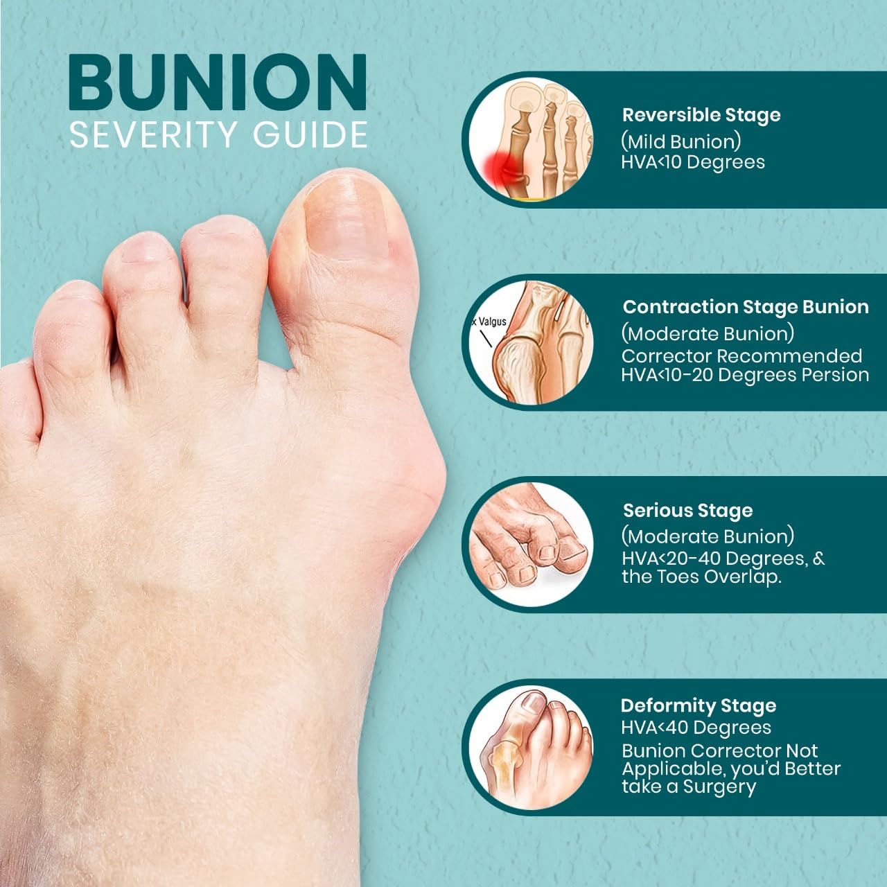 RFAQK Bunion Corrector for Women & Men, Orthopedic Bunion Relief Kit with Big Toe Separator, Spacers & Straighteners, Adjustable Toe Splint, Exercise Strap for Hallux Valgus Correction(1 Pcs)