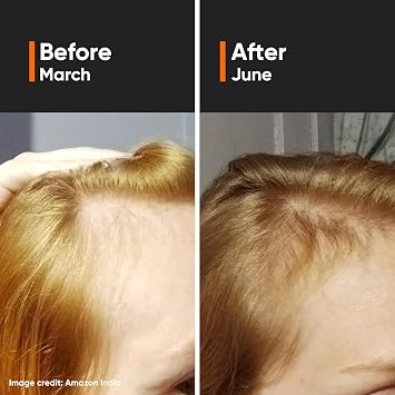 RF Hair Growth Serum With 3% Redensyl, 3% Anagain, 3% Procapil, 5% Capixyl & 4% Baicapil 18% Hair Growth Actives | For Hair Fall Control | For Men & Women | 30 ml