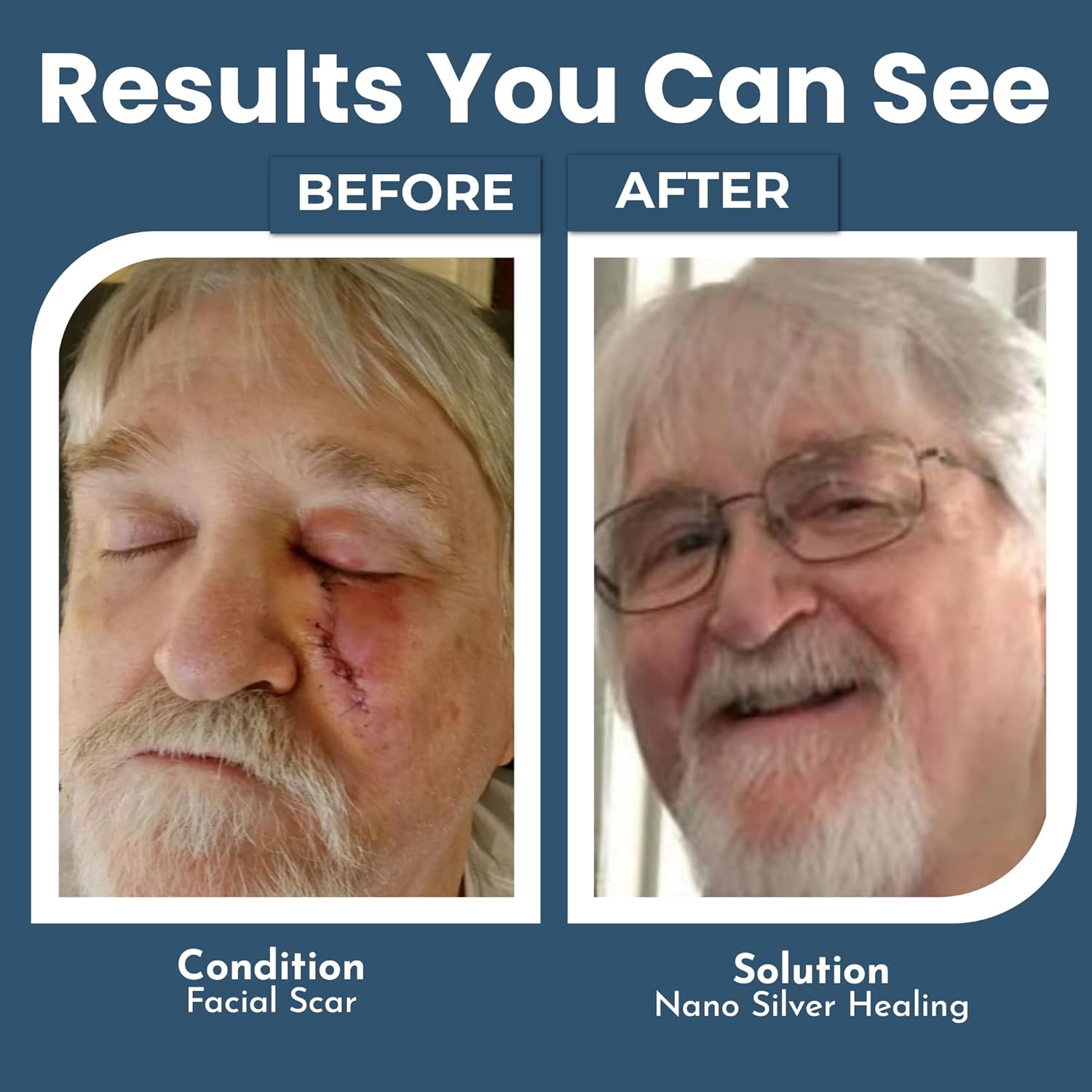 OPTIVIDA Colloidal Silver Gel for Wound Care, Natural Topical Skin Healing | Nano-Silver Topical Gel for Wounds, Burns, Rashes, Skin Irritations, Unscented