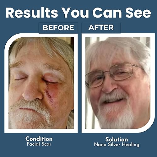 Miniatura 4 de OPTIVIDA Crema de gel de plata coloidal para el cuidado de heridas, curación tópica natural de la piel  Gel tópico de nano-plata para heridas,