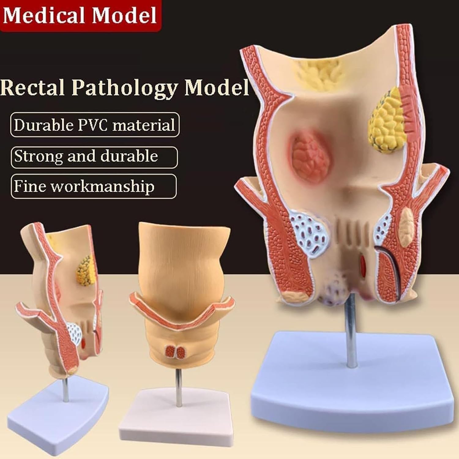 Rectal Ulcer Anatomical Model,Anatomical Human Rectum Pathology Lesion Model Hemorrhoids Anus Medical Teaching