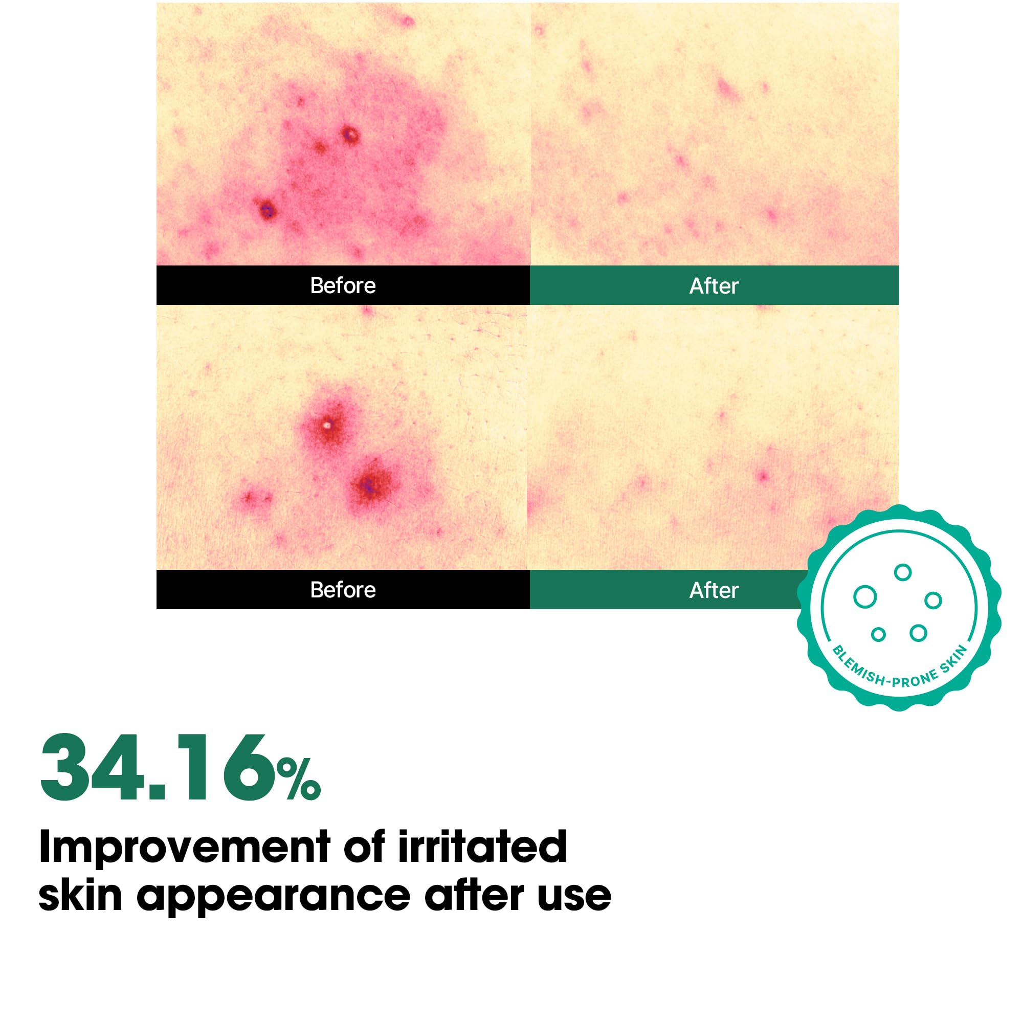 SOME BY MI AHA BHA PHA 30 Days Miracle Toner Mist – 140 ml – Spray pour l'acné corporel pour le dos et la poitrine, exfoliant avec acide salicylique, arbre à thé, niacinamide – Soin coréen de la peau
