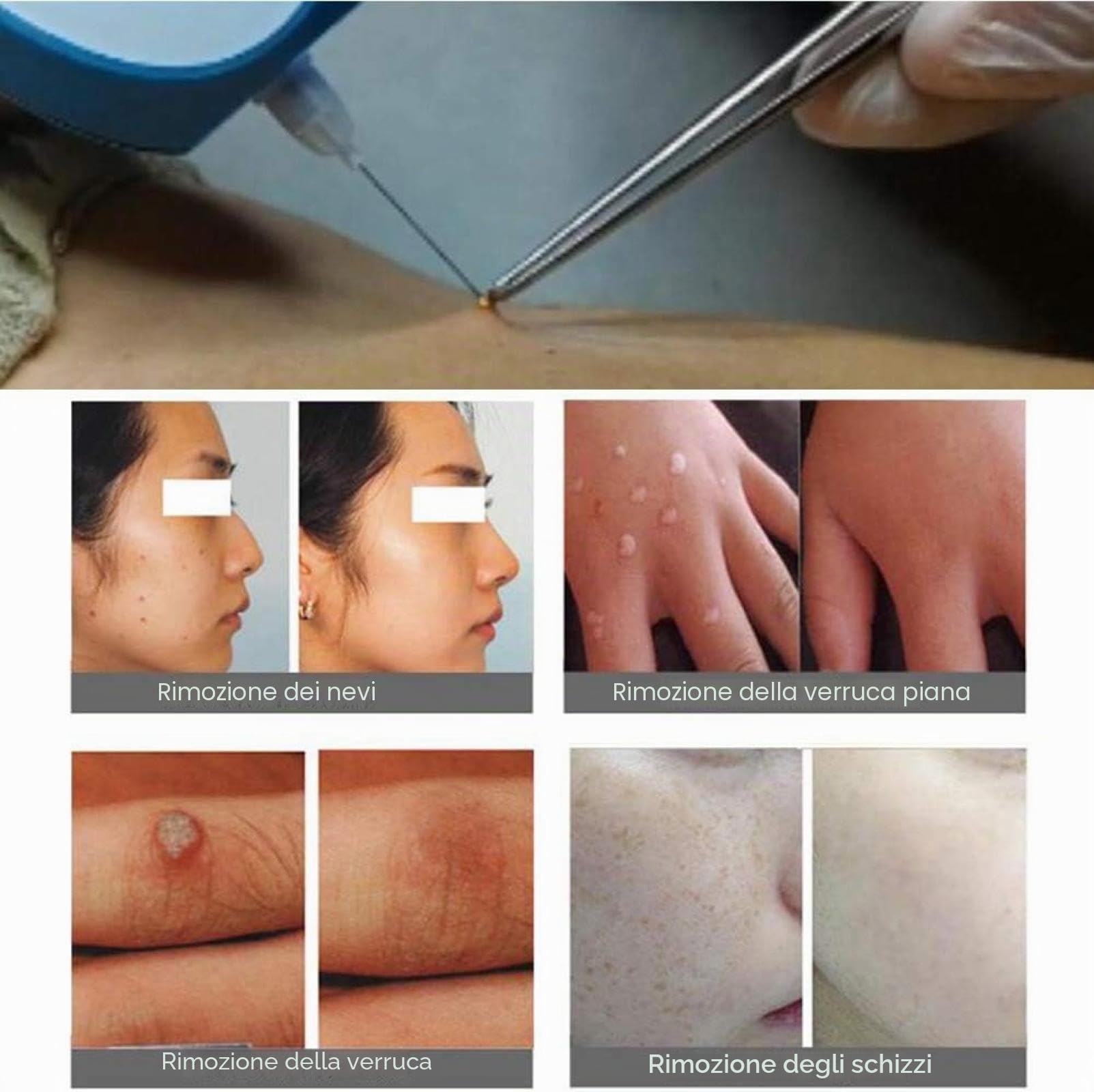 Penna al plasma professionale per la cura della pelle, dispositivo per la rimozione di macchie scure e imperfezioni, bianco e blu