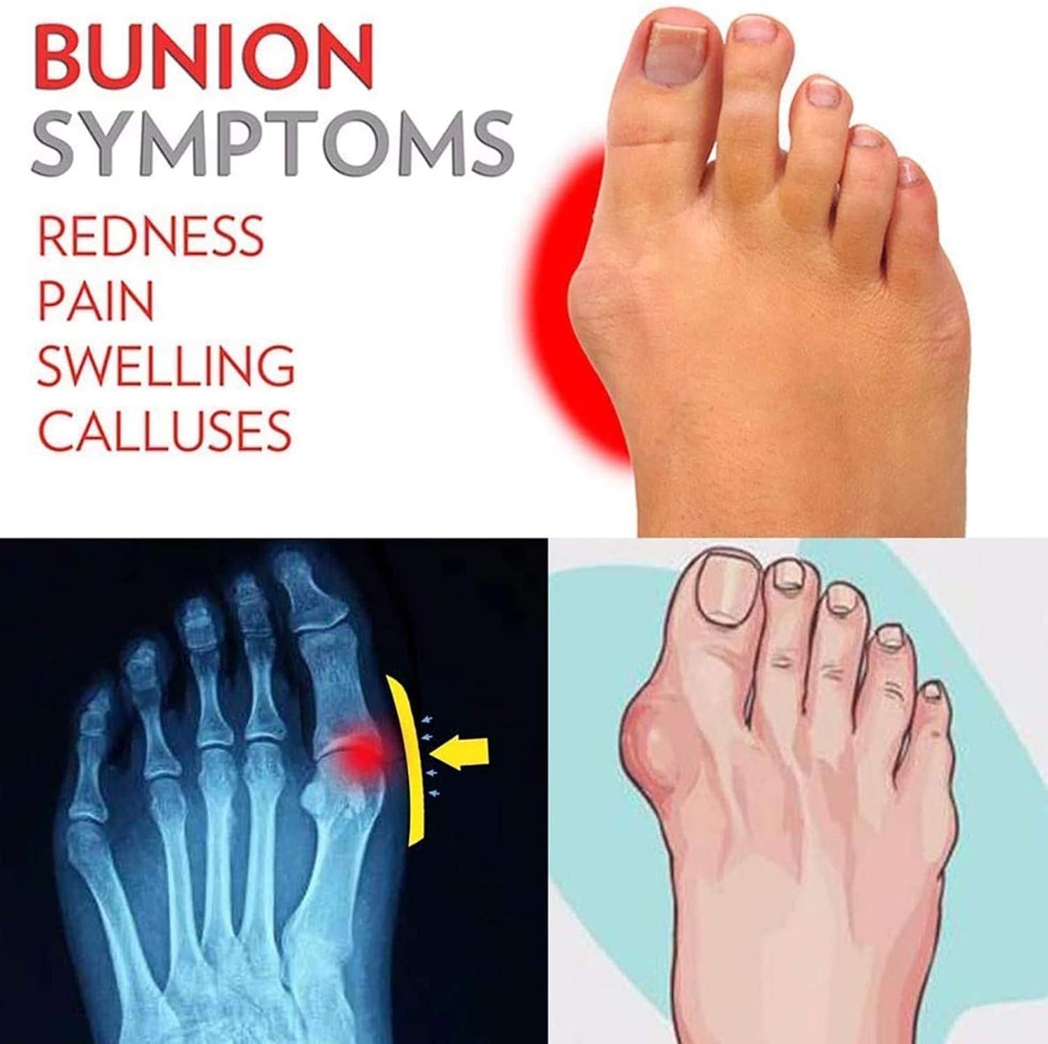 Sandalia De Hombre Big Toe Hallux Valgus, Férulas De Juanete Planas, Chanclas Correctoras De Pie, Cómodas, para Corrector De Dedos, Brown, 6.5 UK