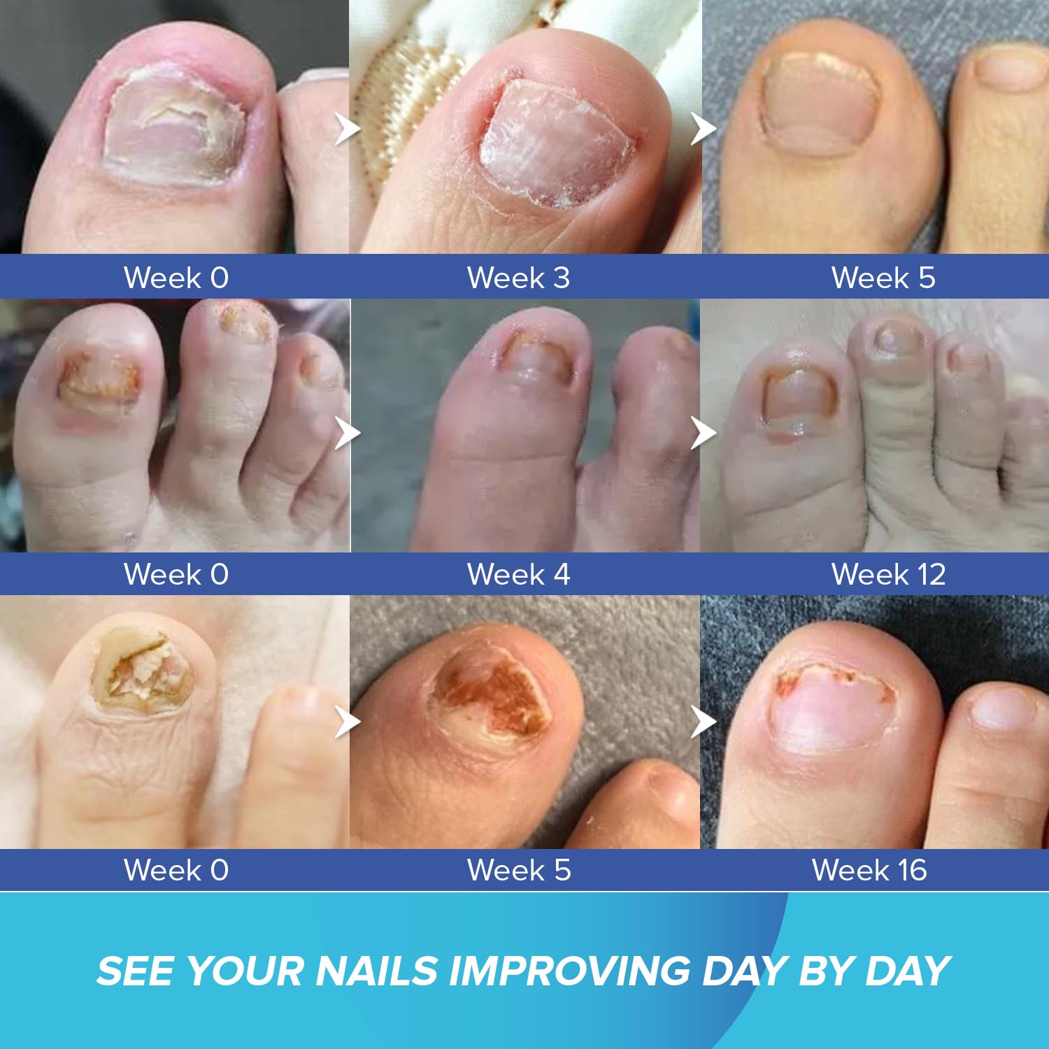 Toenail Fungus Treatment Extra Strength - Nail Fungus Treatment for Toenail - Toe Nail Fungus Treatment Extra Strength - Nail Fungus Treatment, 1 fl oz