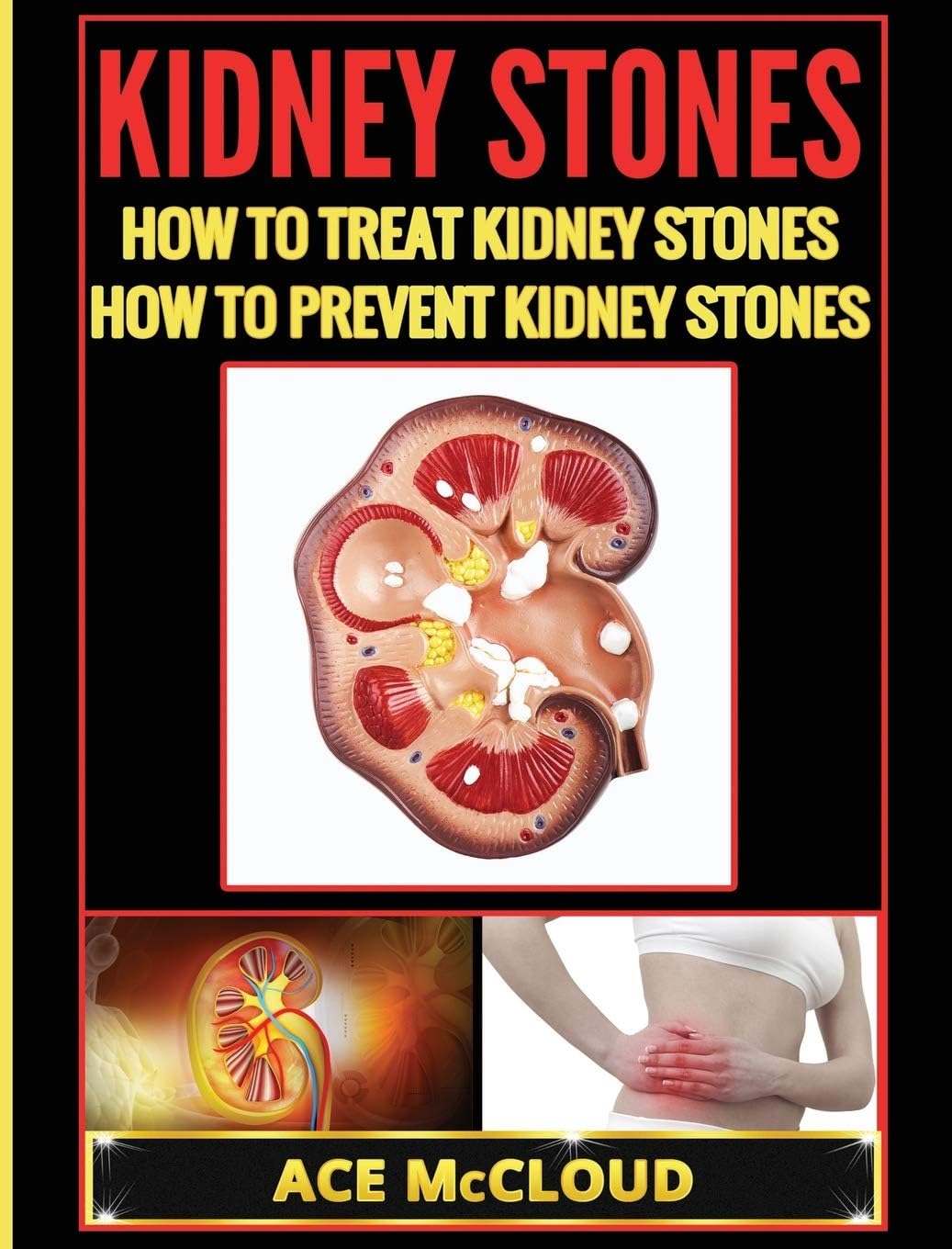 Kidney Stones: How To Treat Kidney Stones: How To Prevent Kidney Stones (Kidney Stone Treatment & Prevention Guide with All) Hardcover โ 17 Mar. 2017
