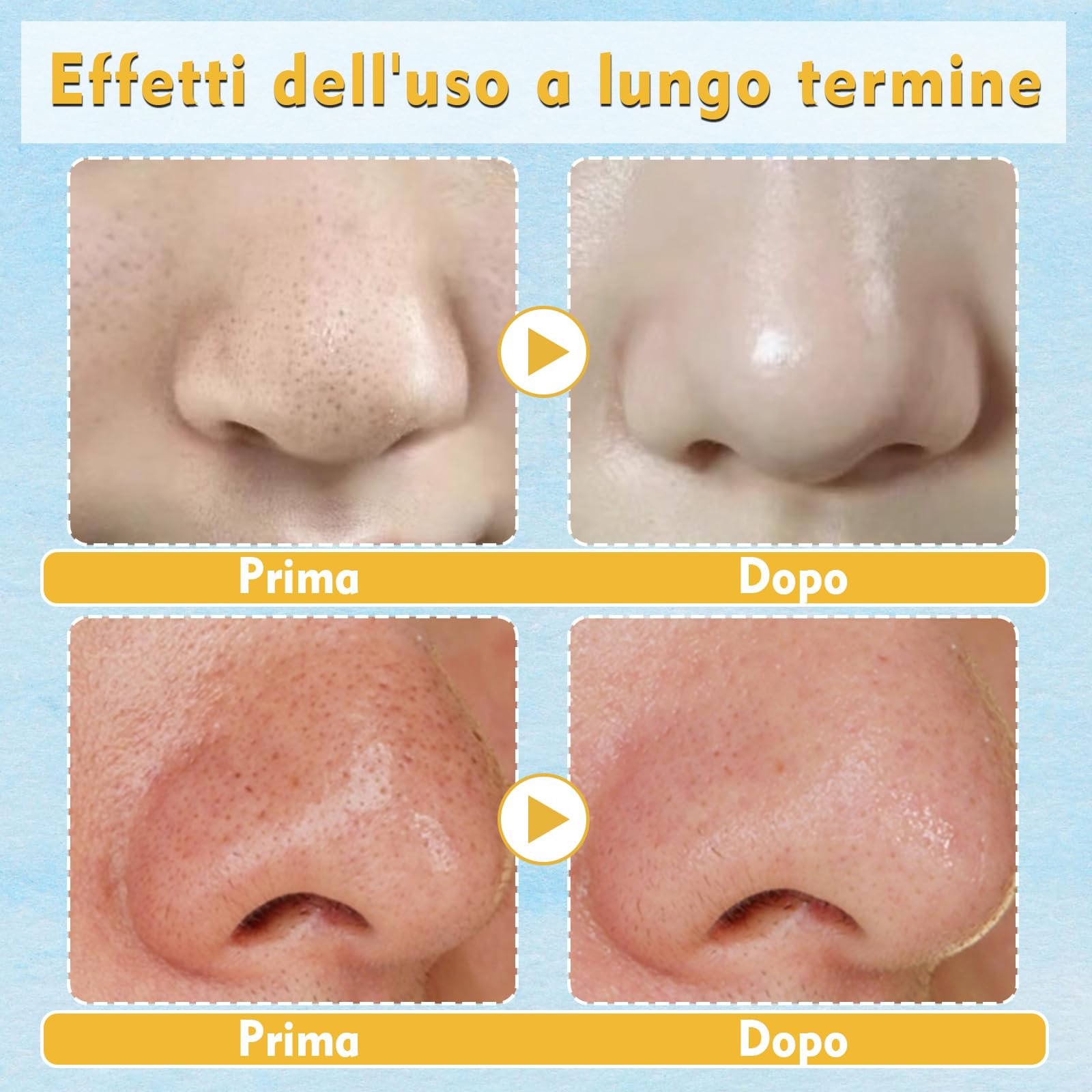 20 Cerotti Punti Neri Naso - Patch con Tecnologia Idrocolloide per la Rimozione di Punti Neri, Pori Puliti e Ridotti, Ideali per Tutti i Tipi di Pelle (20)