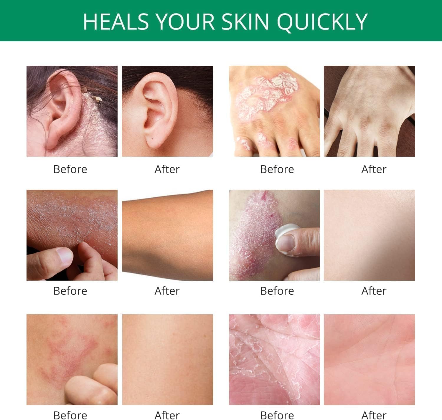 Hermon Psoriasis Eczema Relief Cream: Maximum Strength for Psoriasis Eczema - Relieve Symptom of Resistant Effective for Seborrheic Dermatitis Folliculitis 100m 3.4 Fl Oz (Pack of 1) - Image 5