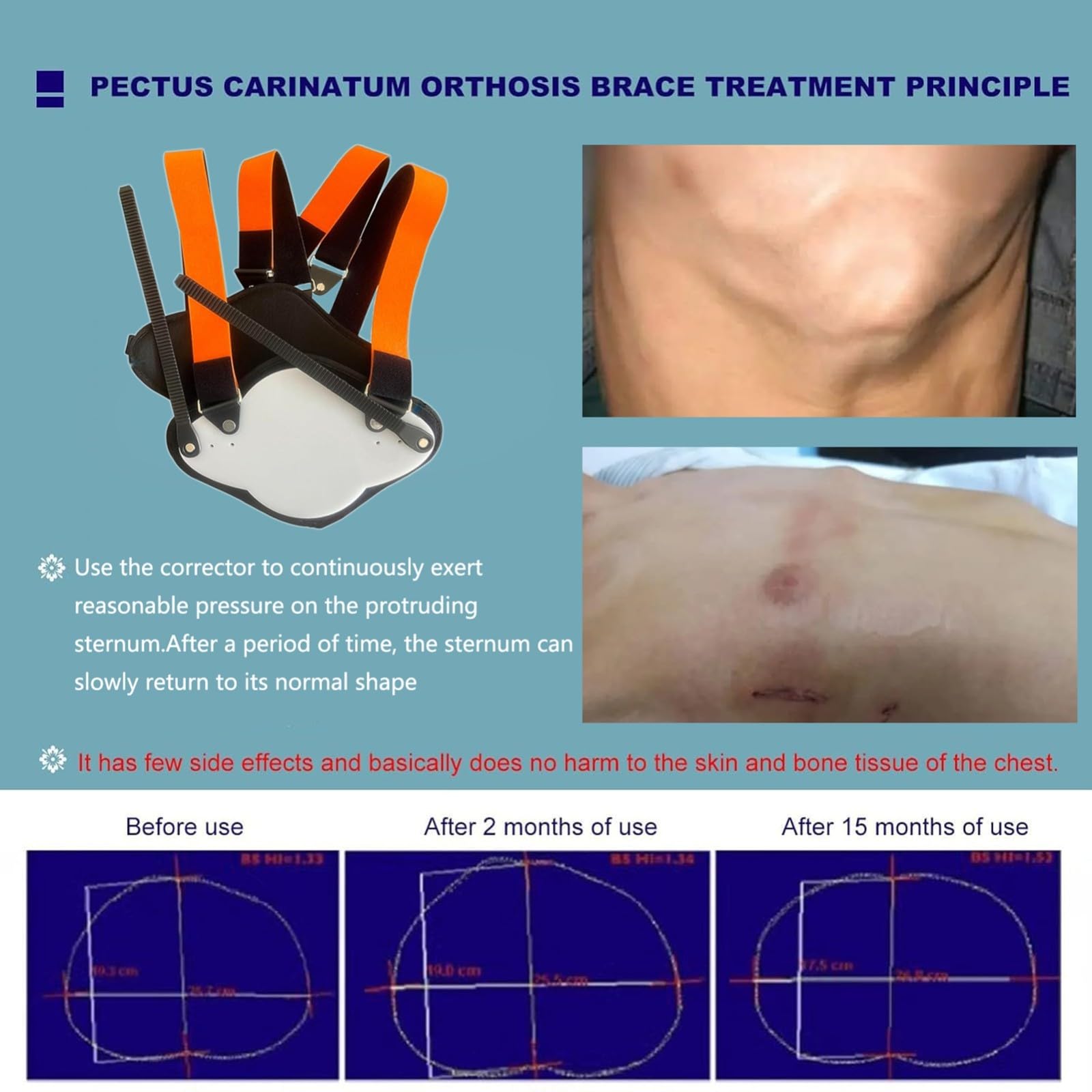 Pectus Carinatum Brace - Ortesis de fijación torácica ajustable para todas las edades - Soporte corrector de costillas valgus