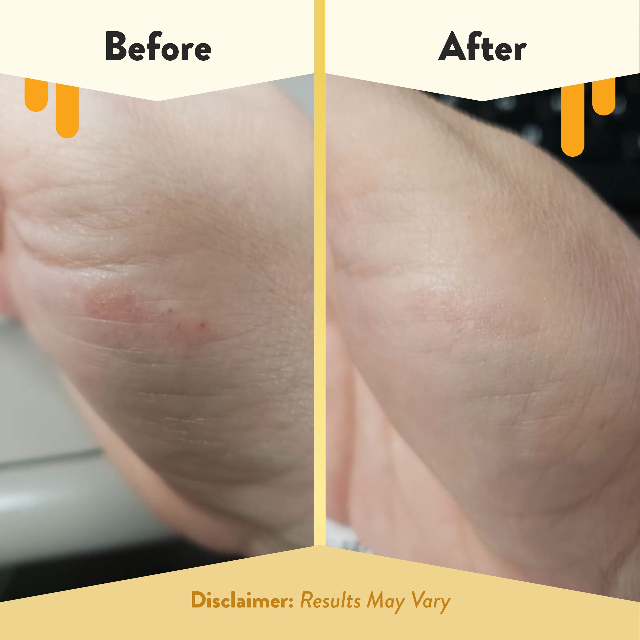 ECZEMA HONEY Juckreiz kühlende Gesichts- und Körper-Runden, Anti-Juckreiz Baumwoll-Gesichtspads, Feuchtigkeitscreme für Ekzeme, trockene und empfindliche Haut (50 Baumwoll-Runden)