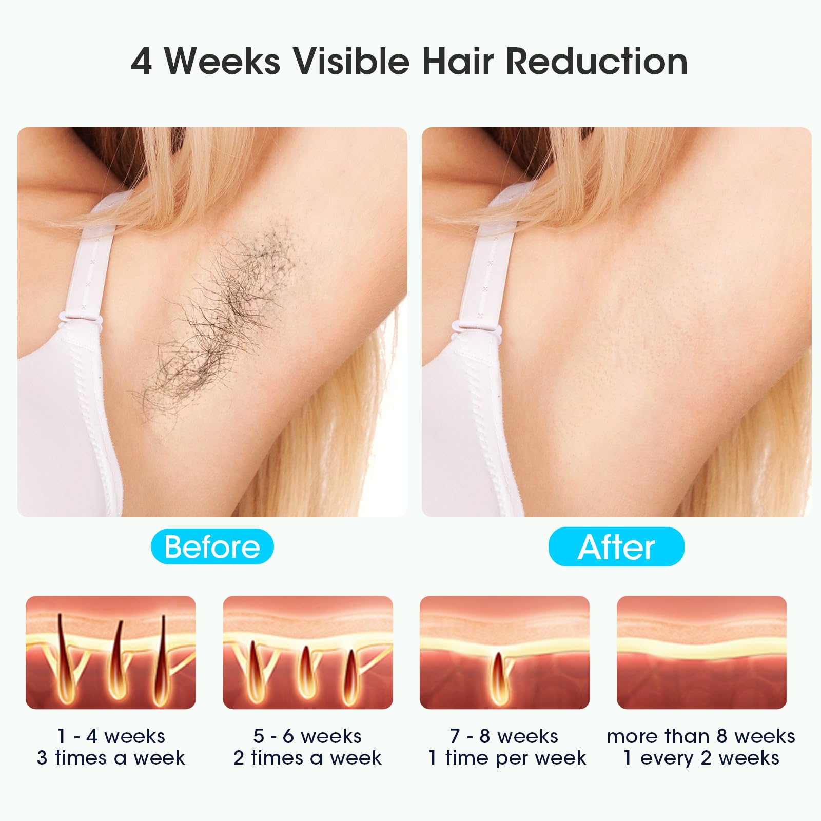 MLAY Épilation laser sans douleur avec glace 5 niveaux d'énergie