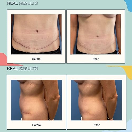 Miniatura 6 de SUNNIE ScarSmooth Gel para cicatrices  1.7 fl oz I Crema de cicatrices avanzada de grado médico para cicatrices quirúrgicas, sección C, quemaduras y