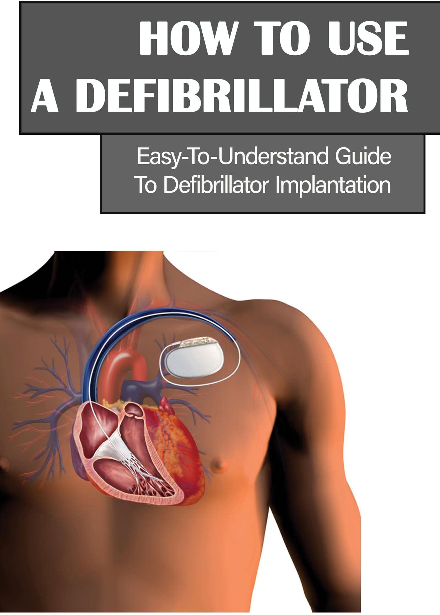 How To Use A Defibrillator: Easy-To-Understand Guide To Defibrillator Implantation